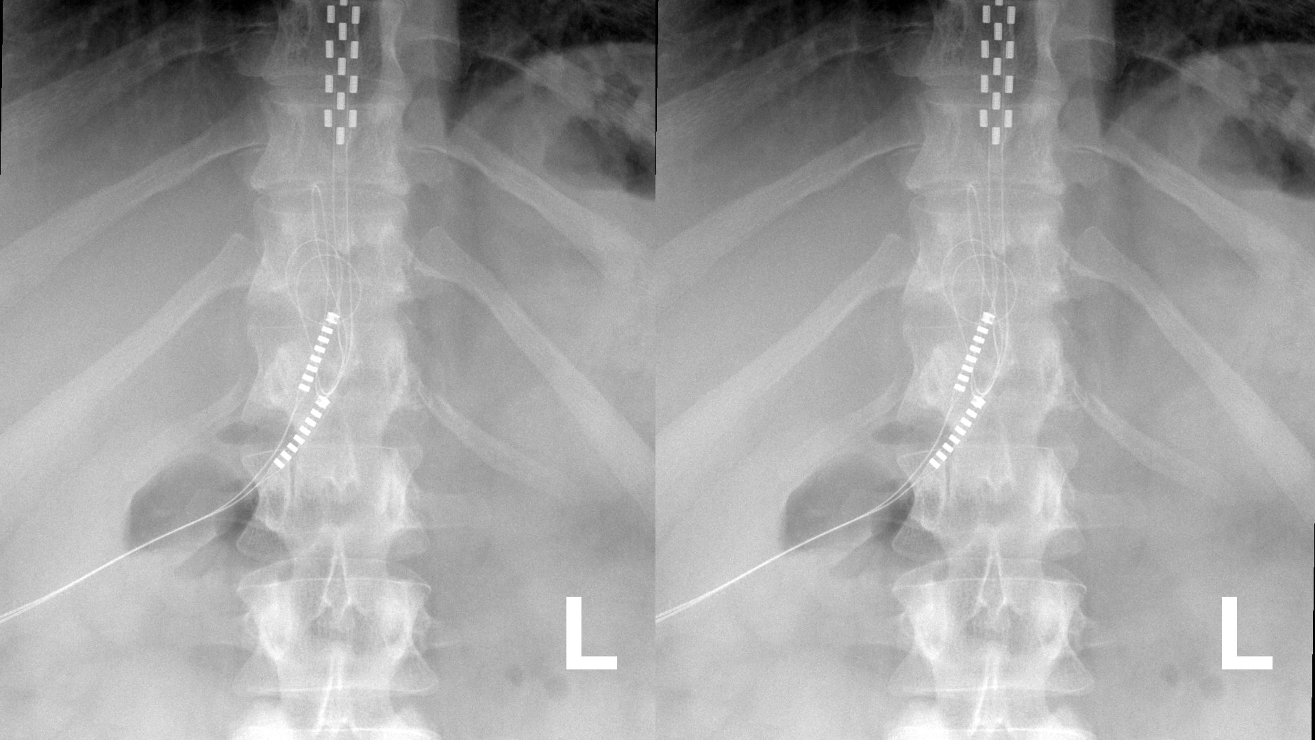 TGA Reveals Concerning Post-Market Review of Spinal Cord Stimulators image